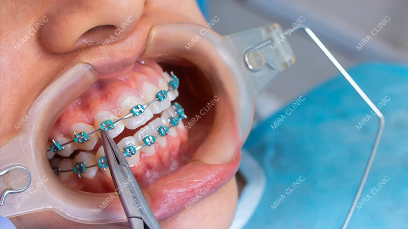 Orthodontic Treatment